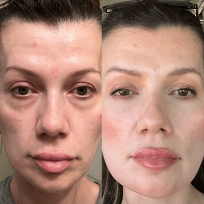 OptiLight™ Eye Therapy