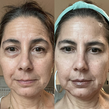 OptiLight™ Eye Therapy