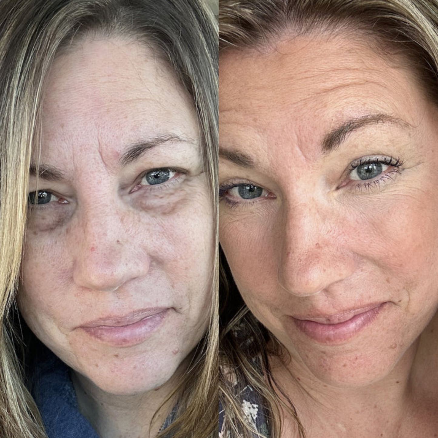 OptiLight™ Eye Therapy